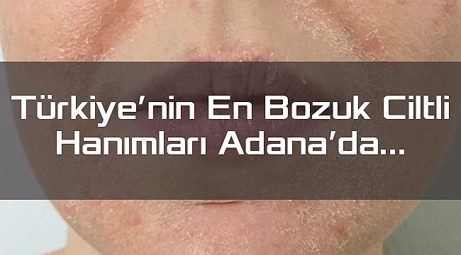 Türkiye'nin En Bozuk Ciltli Hanımları Adana'da…