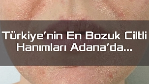 Türkiye'nin En Bozuk Ciltli Hanımları Adana'da…